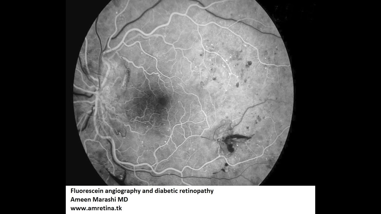 Fluorescein angiography and diabetic retinopathy