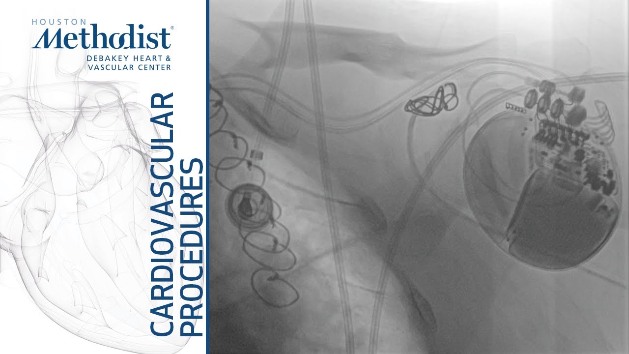 Endovascular Treatment of Iatrogenic Subclavian Arteriovenous Fistula (Alan B. Lumsden, MD)
