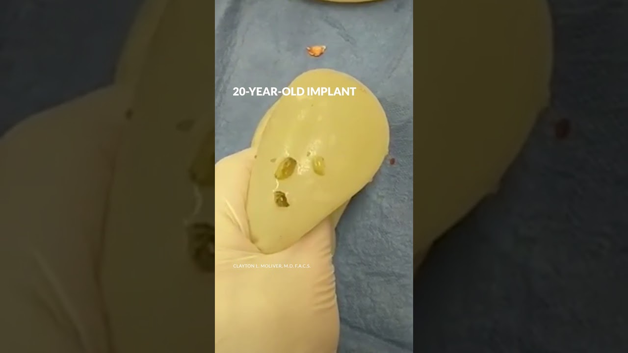 This is what a 20 year old implant looks like! #shorts #breastimplant #breastaugmentation