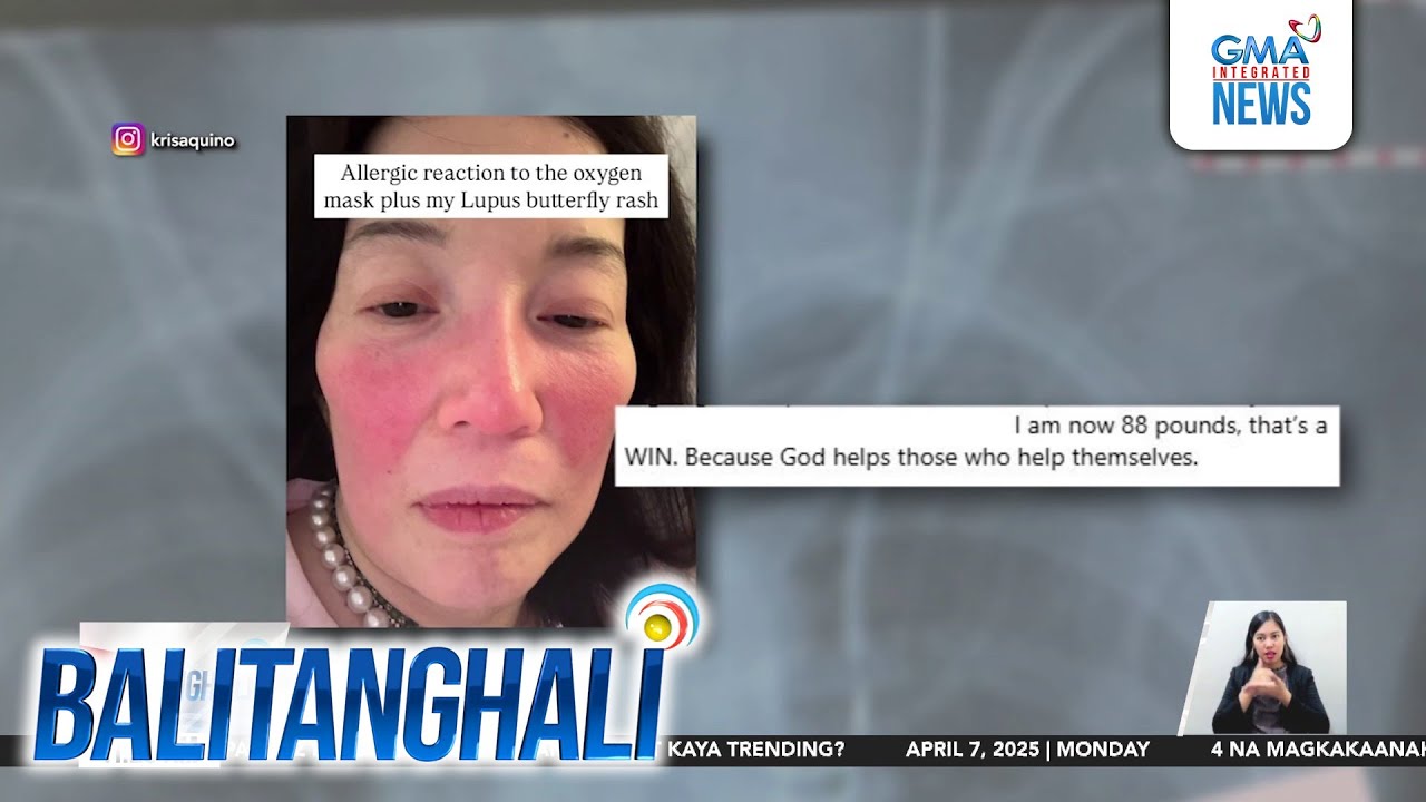 Tubong nakadugtong sa ugat ni Kris Aquino, kinailangang palitan... | Balitanghali