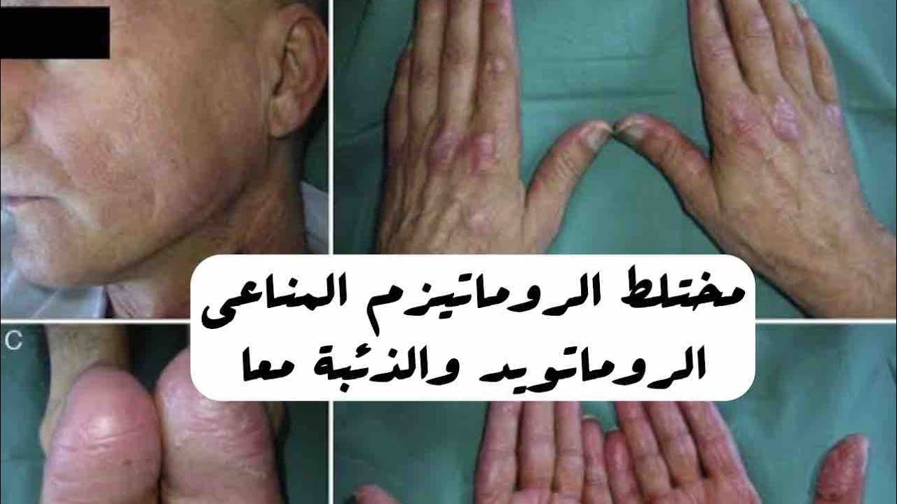 مختلط الروماتيزم المناعي (النسيج الضام) الروماتويد والذئبة معا