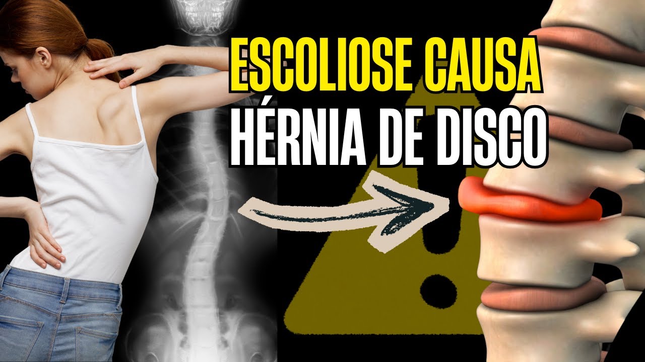 Especialista Revela COMO TRATAR Escoliose e Prevenir Hérnia de Disco