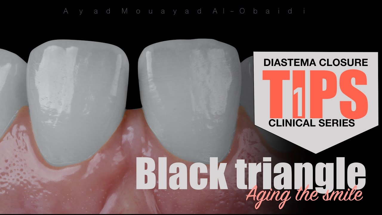 Black triangle diastema closure clinical tips series
