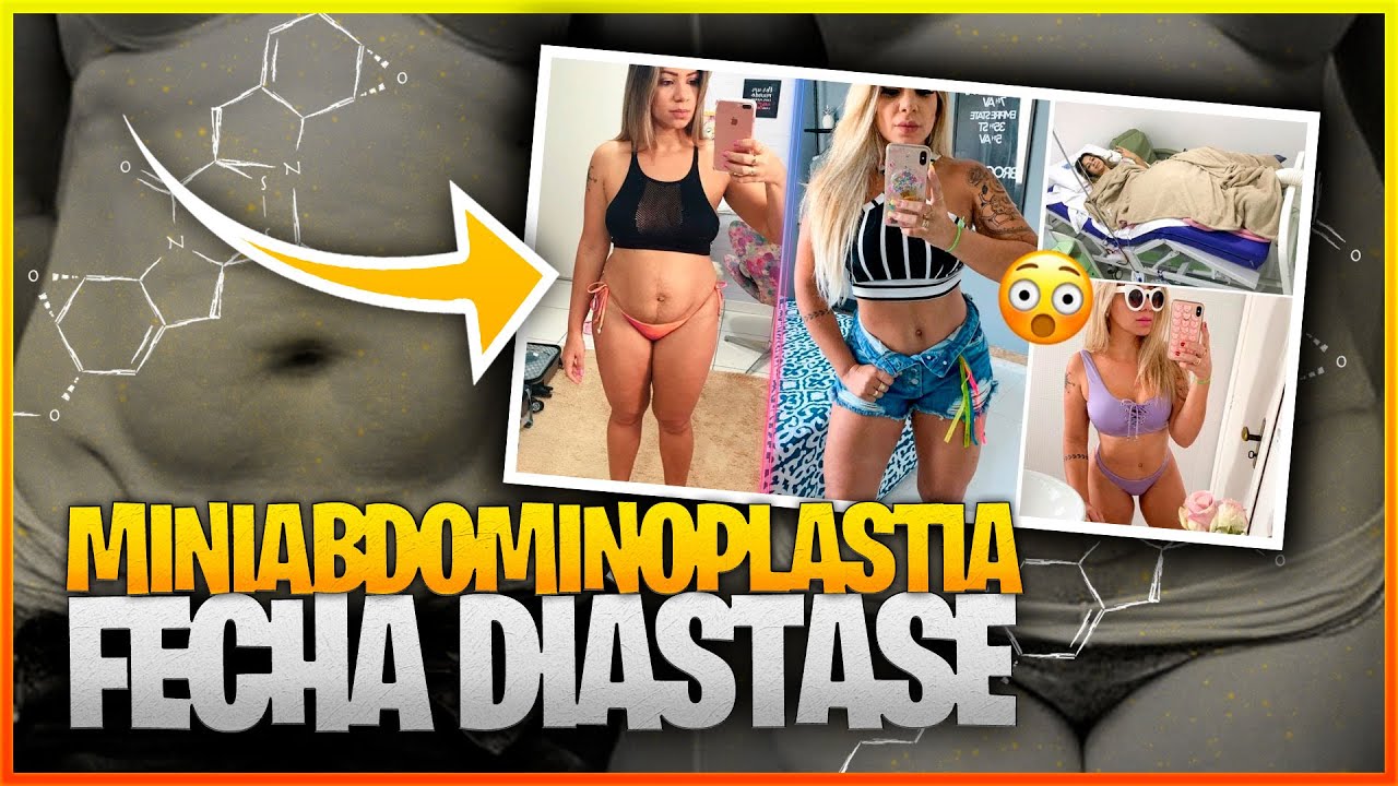 MINI ABDOMINOPLASTIA FECHA DIÁSTASE E TIRA HERNIA UMBILICAL?