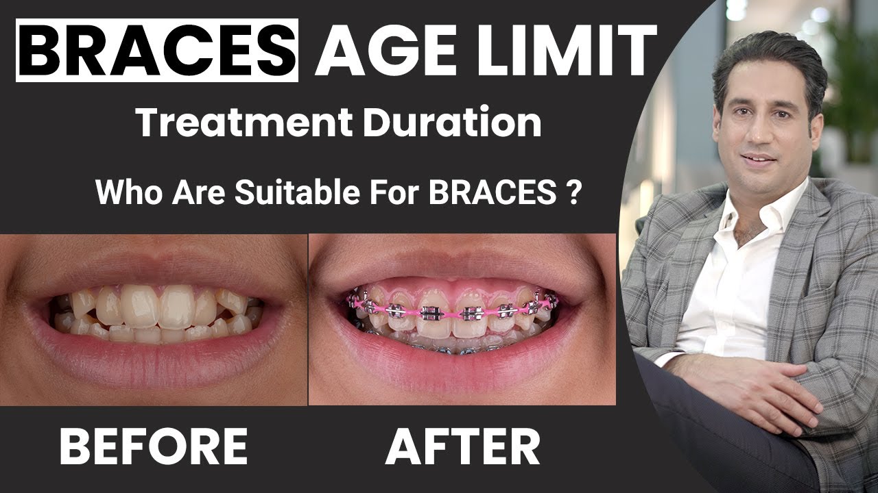 Braces in Lahore | Types, Age Limit And Treatment Duration | Dr. Shahzad Mirza | Dental Aesthetics