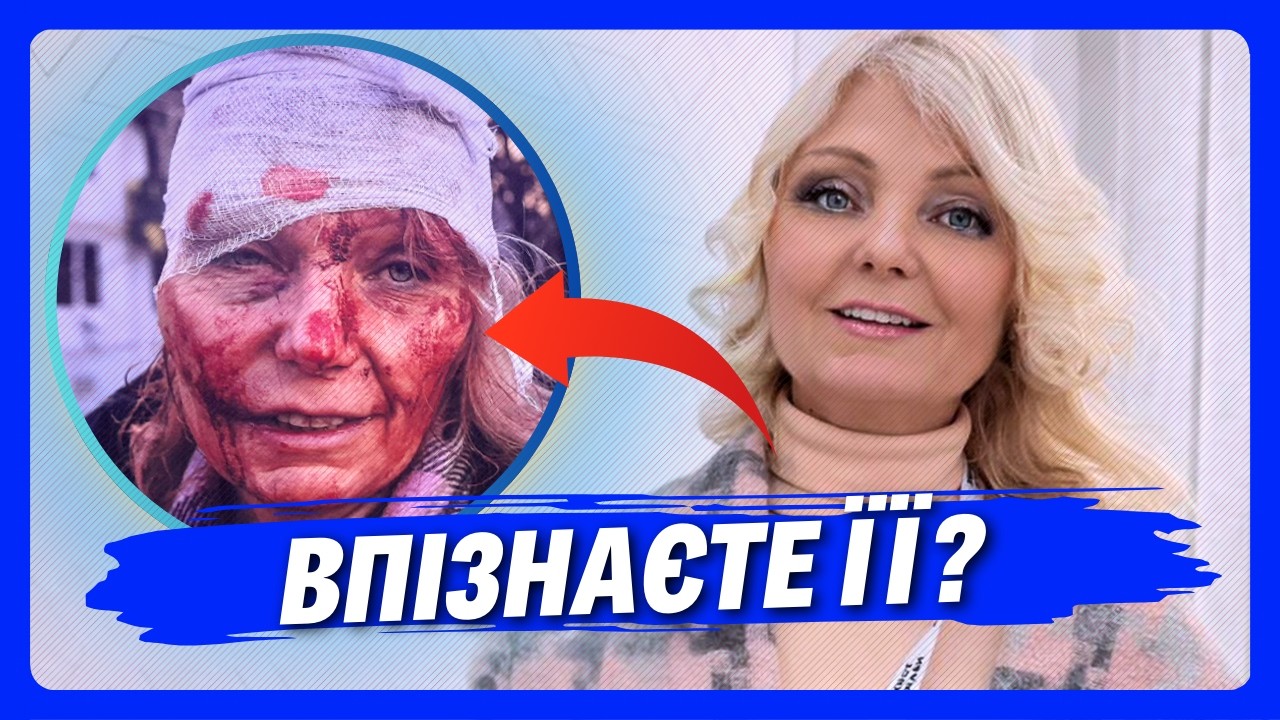 Її фото ОБЛЕТІЛО ВЕСЬ СВІТ на початку війни. Як скалалася доля жінки, яку ПОРАНИЛО уламком? Дивіться