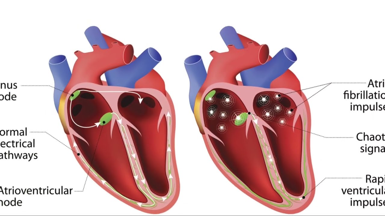 ECG Mastery: Identifying Torsades de Pointes Made Easy