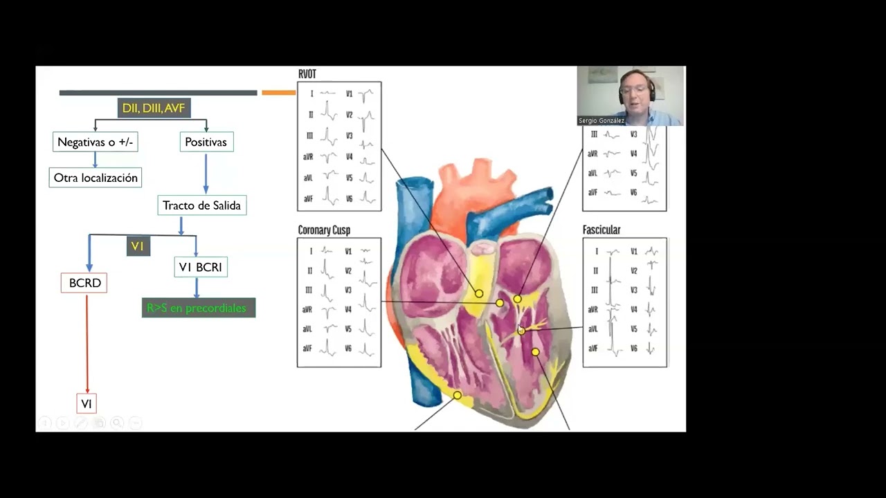 Extrasístoles ventriculares para el cardiólogo clínico