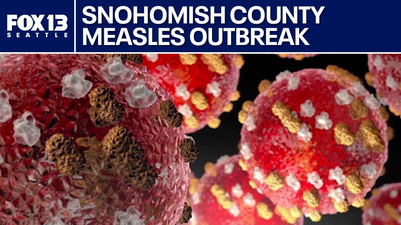Snohomish County concerned about measles spread for World Cup | FOX 13 Seattle