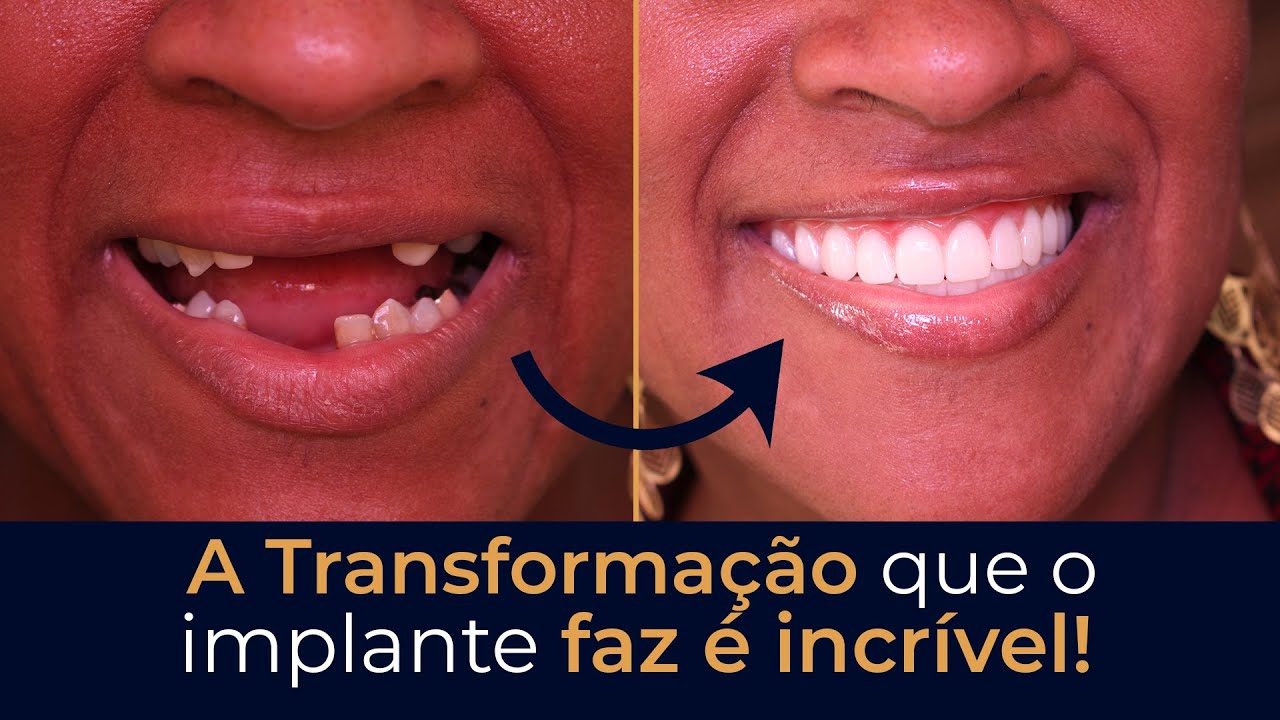 Como o Implante Dentário Pode Transformar Uma Vida - Implace