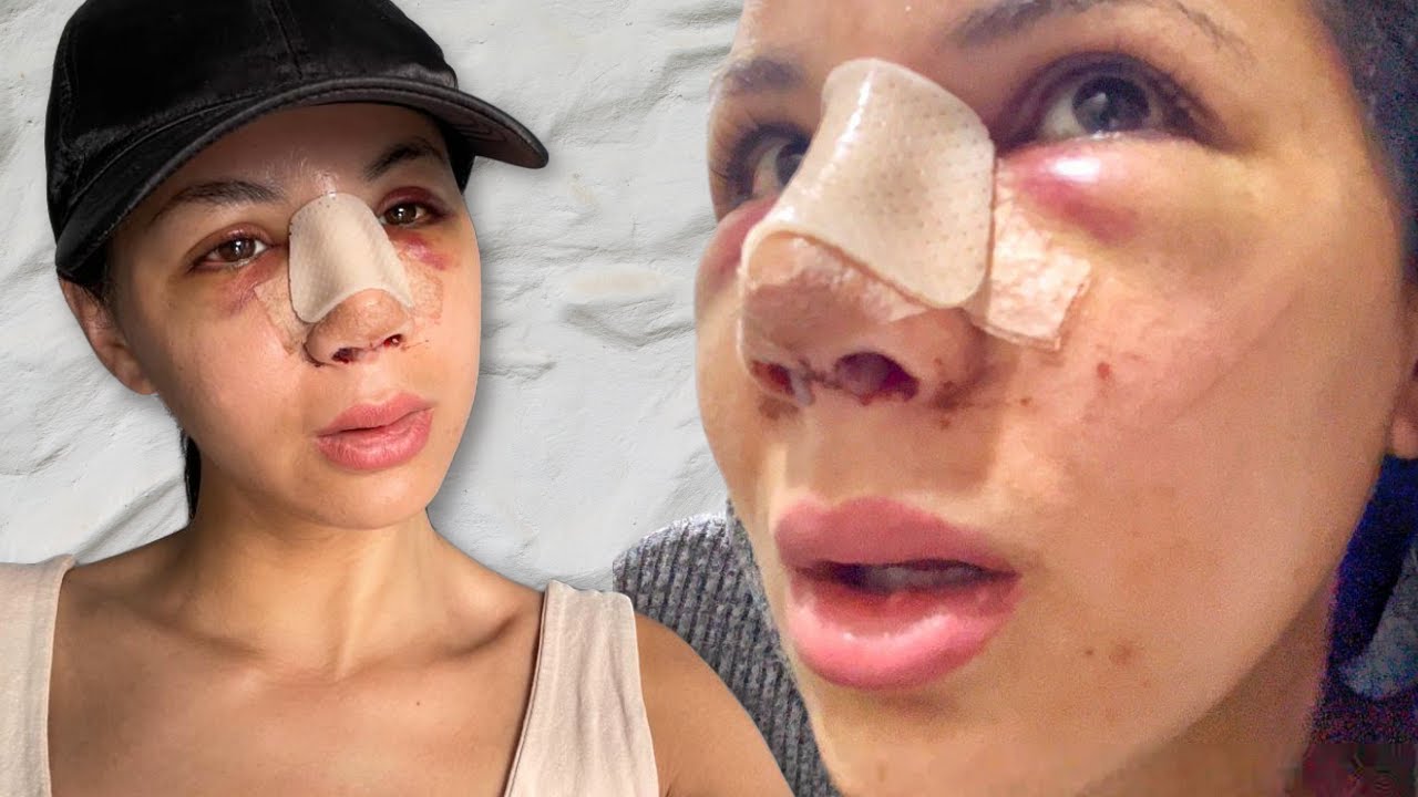 #VLOG - MA RHINOPLASTIE EN TURQUIE (Dr Mirza Firat)