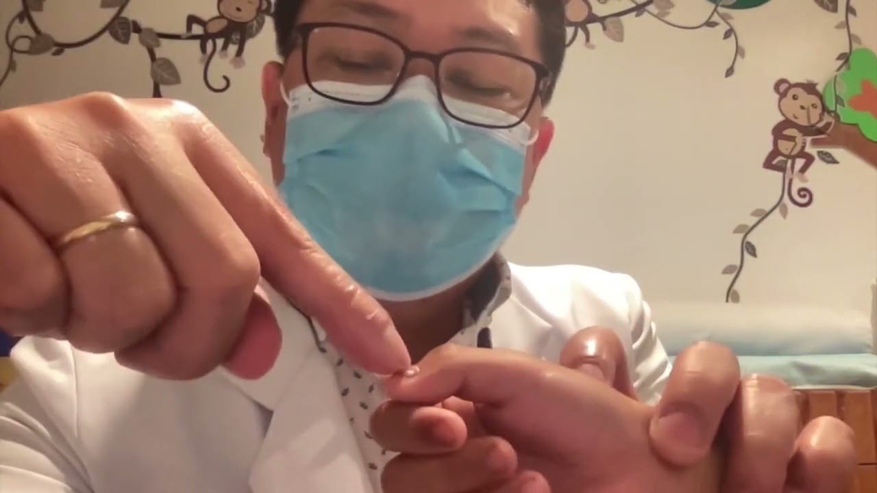 Natangal ang Kuko after nagka Hand Foot Mouth Disease