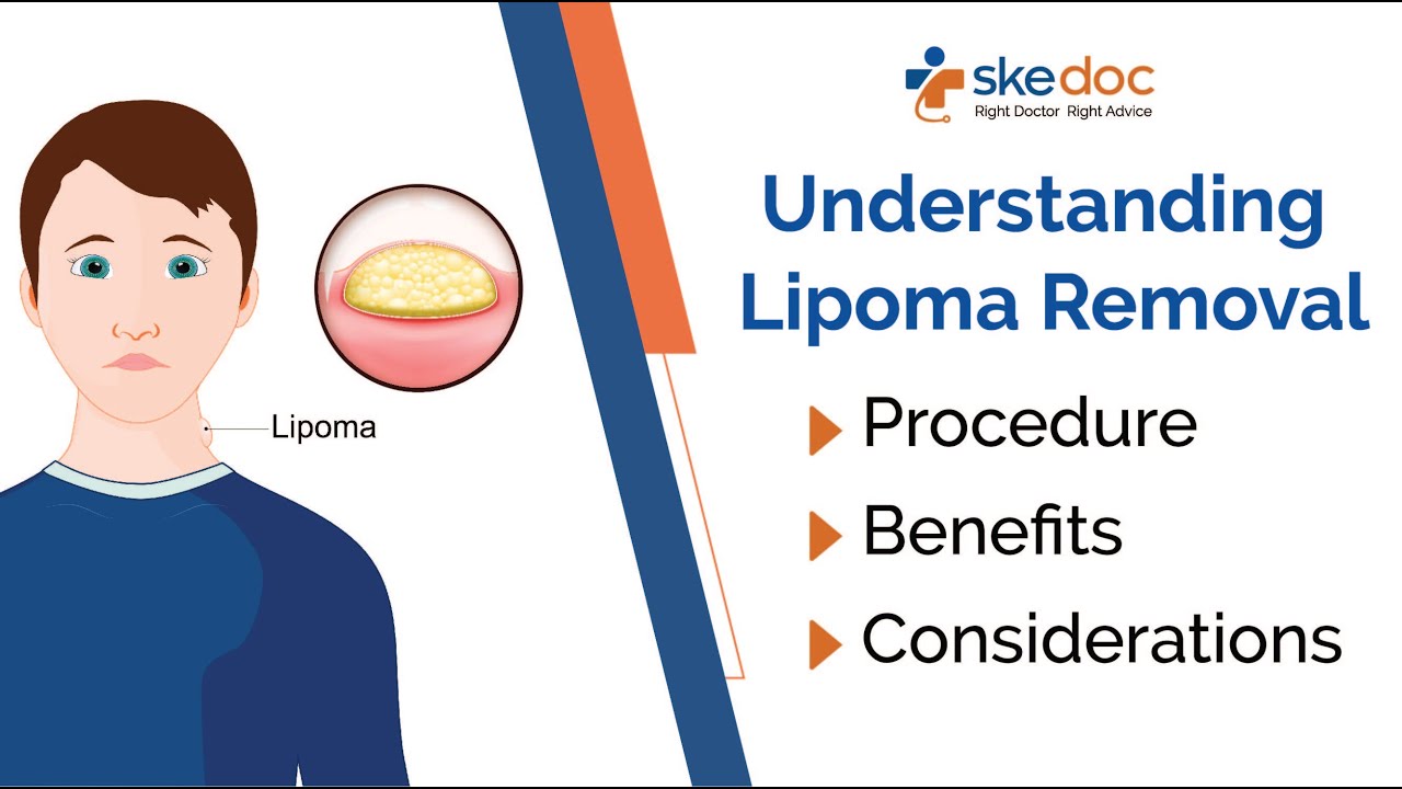 Understanding Lipoma Removal: Procedure, Benefits, and Considerations