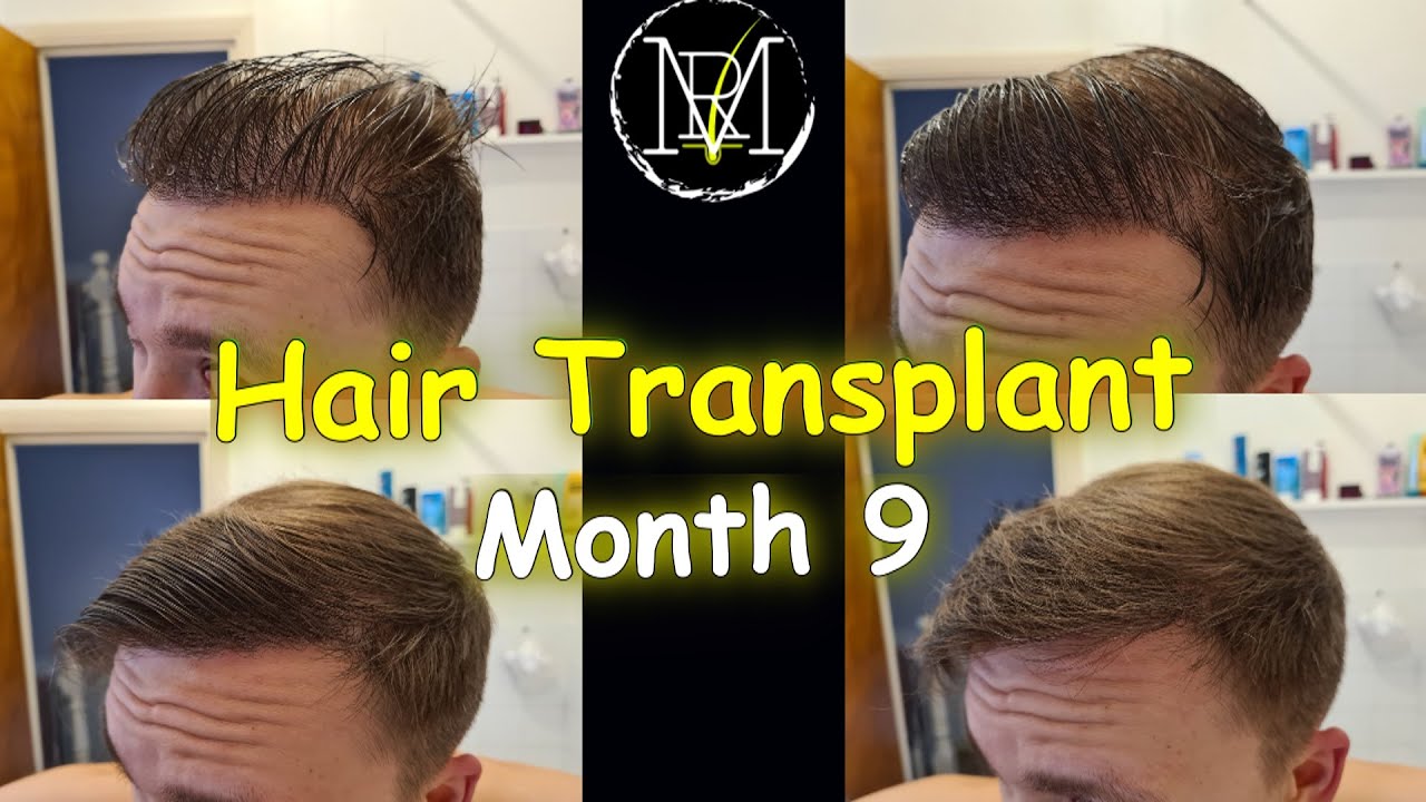 9 months after FUE Hair Transplant | 3500 grafts | Norwood 5a