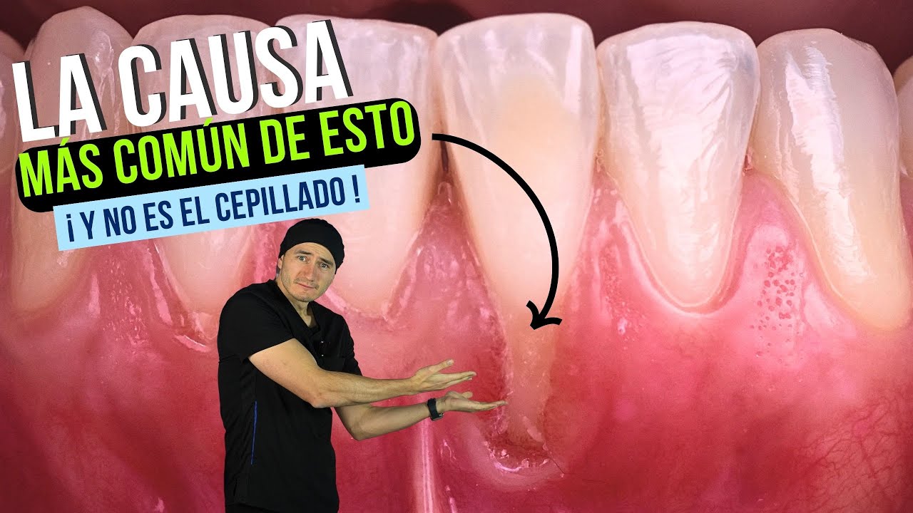 ¿Se te ve la raíz del diente? ¿Tienes dientes sensibles? Causa #1 de encías retraídas