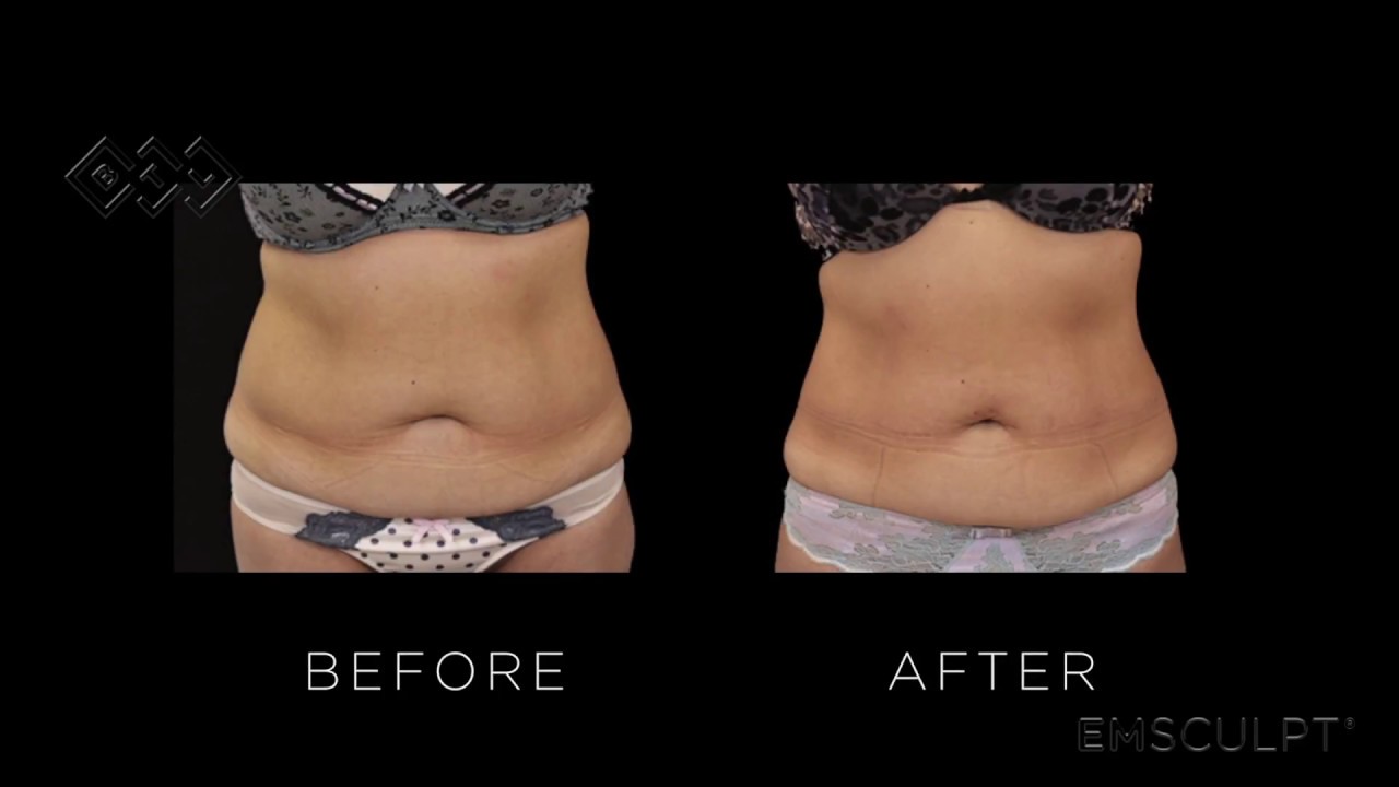 EMSCULPT Reviews | EMSCULPT Beverly Hills, Lasky Aesthetics & Laser Center, Los Angeles