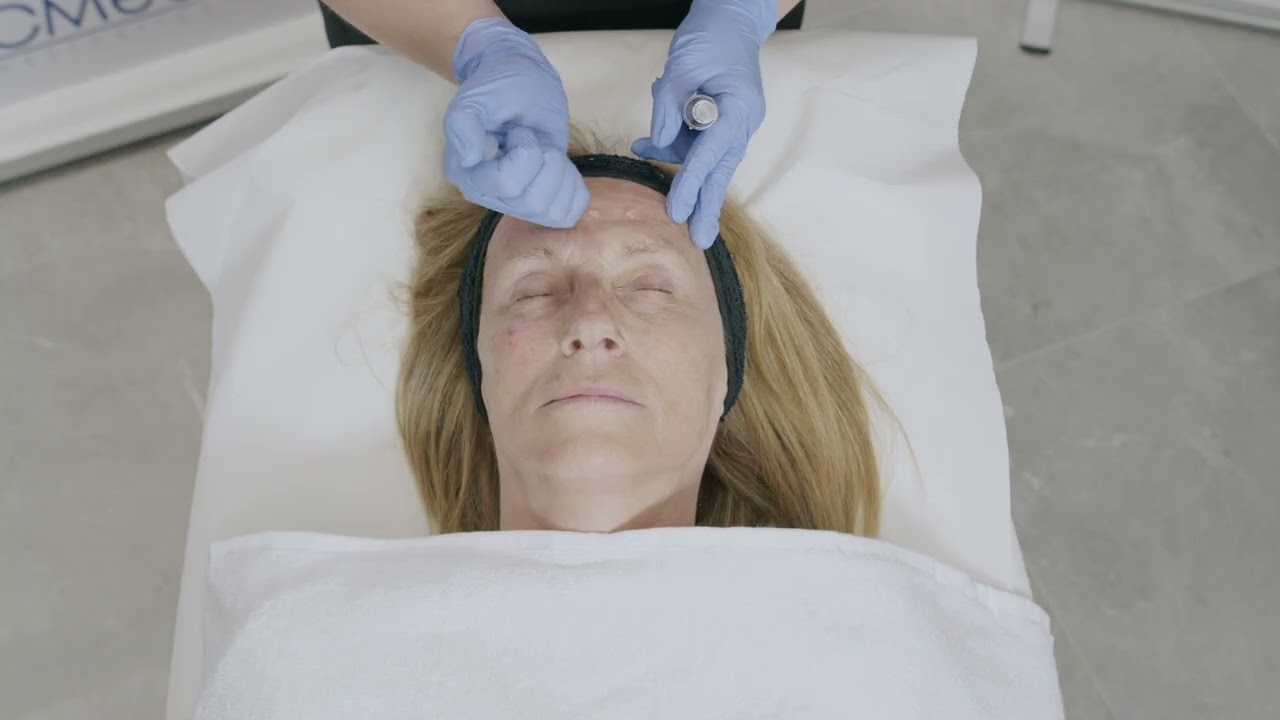 Treatment 7 - ARES® AA + microneedling