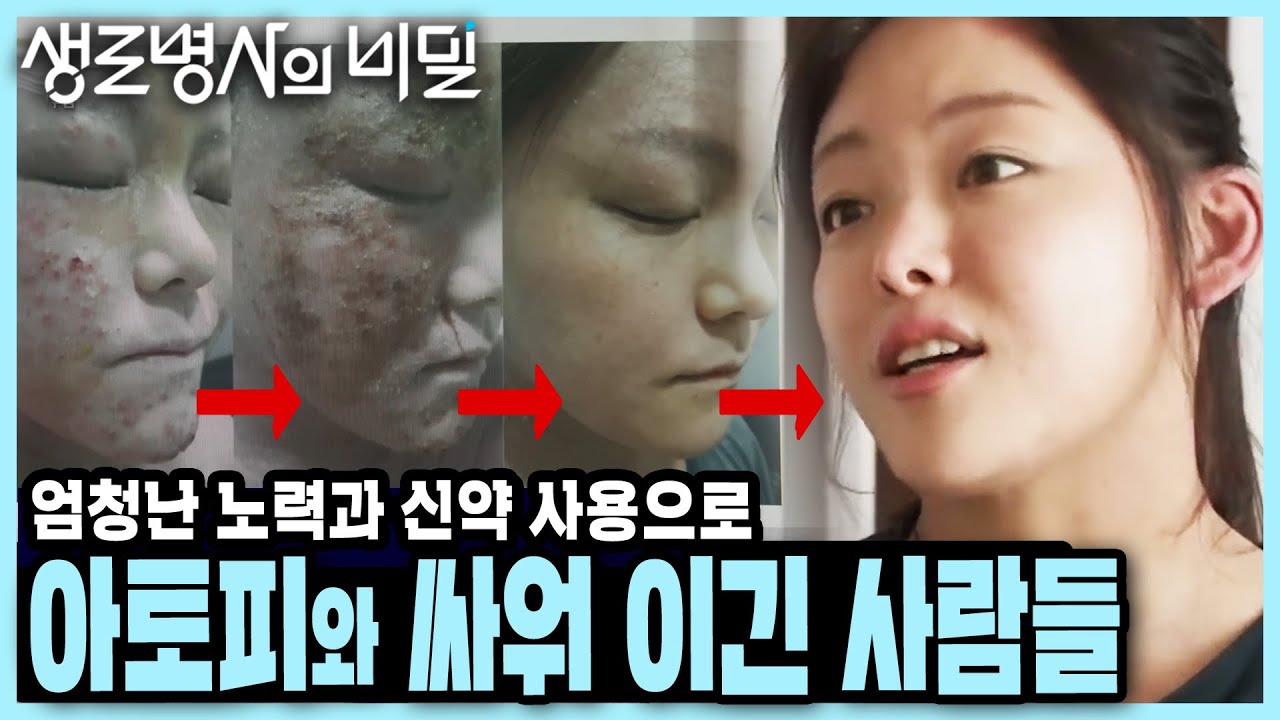 발병 원인과 치료법이 명확하지 않았던 아토피... 꾸준한 노력과 신약 개발로 지긋지긋한 아토피에서 탈출한 사람들 I 아토피 희망이 보인다 I KBS 230628 방송