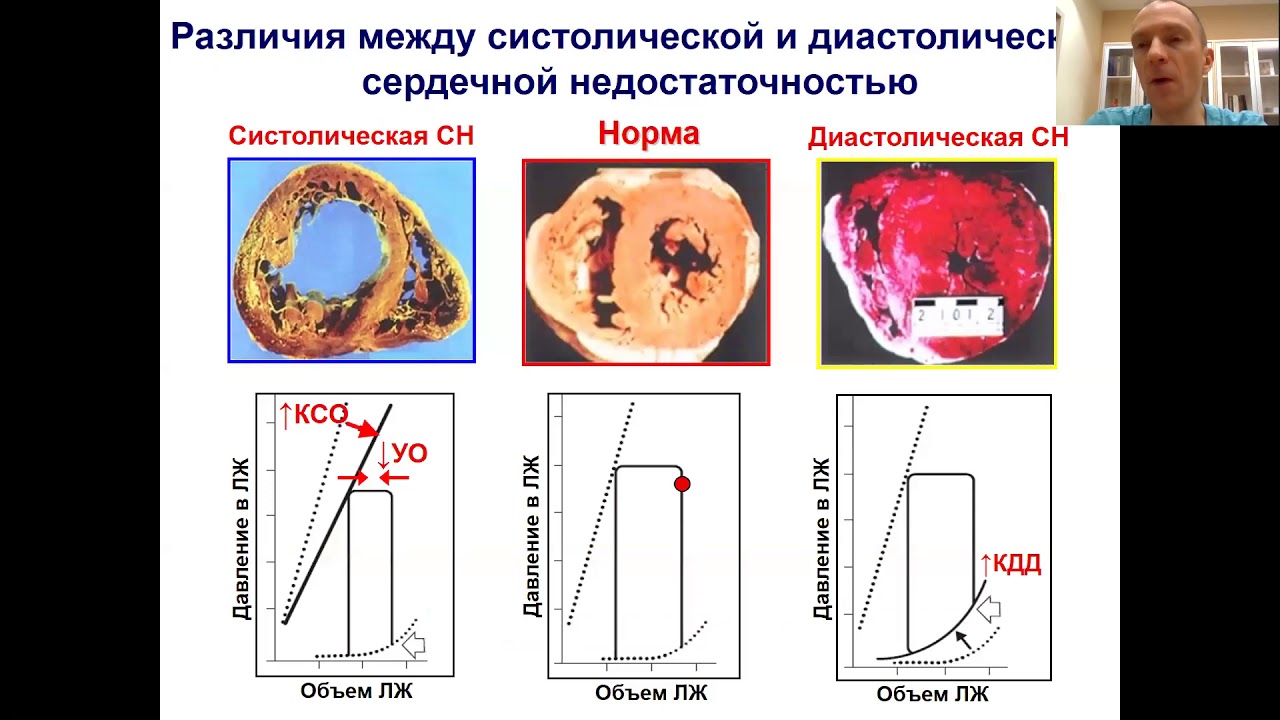 Патофизиология сердечной недостаточности