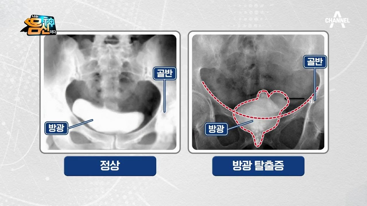 ※충격※ 방광 질환③ '방광 탈출증'...방광이 무너진다? | 나는 몸신이다 263 회