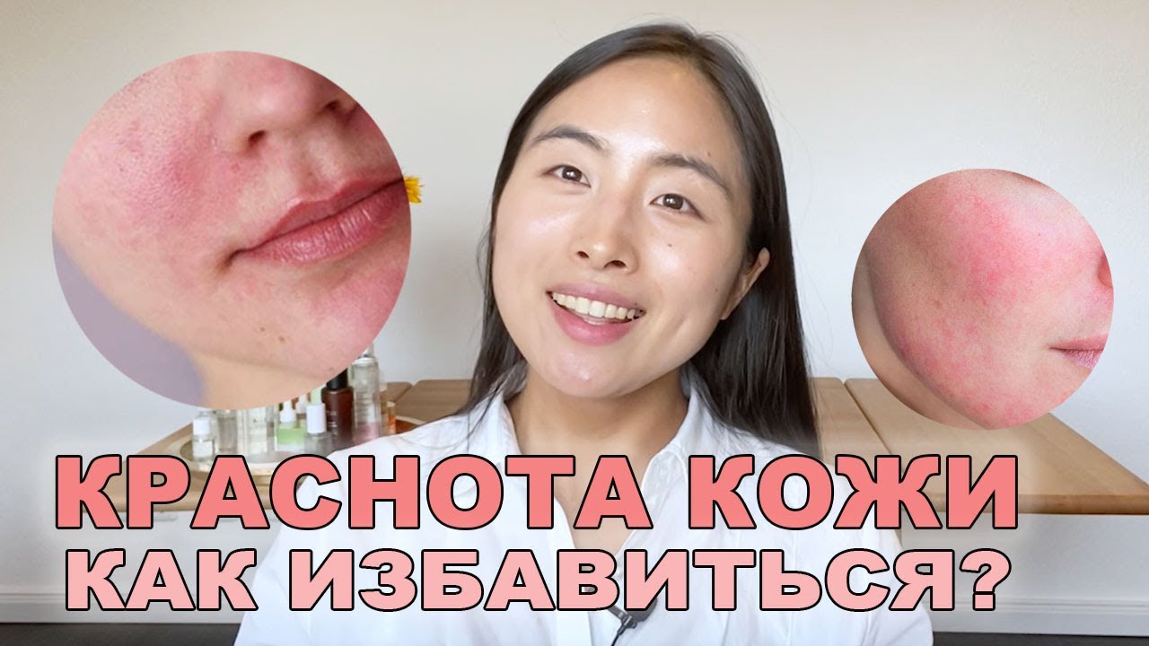 КАК ИЗБАВИТЬСЯ ОТ КРАСНОТЫ КОЖИ? НЕСКОЛЬКО ЛАЙФХАКОВ