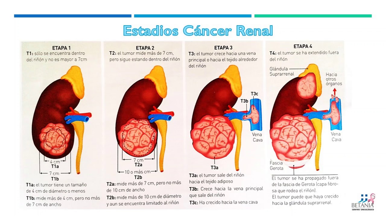 Cáncer Renal