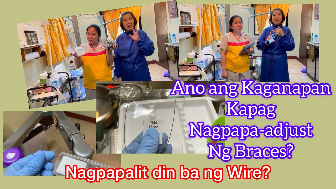 ANONG KAGANAPAN KAPAG NAGPAPA-ADJUST NG BRACES? (Nagpapalit Din Ba ng Wire?)