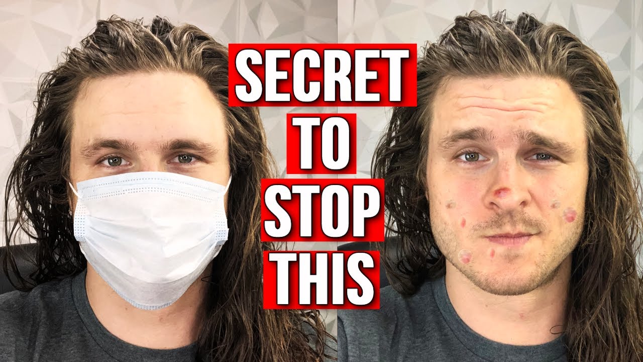 STOP ACNE BREAKOUTS FROM FACE MASKS