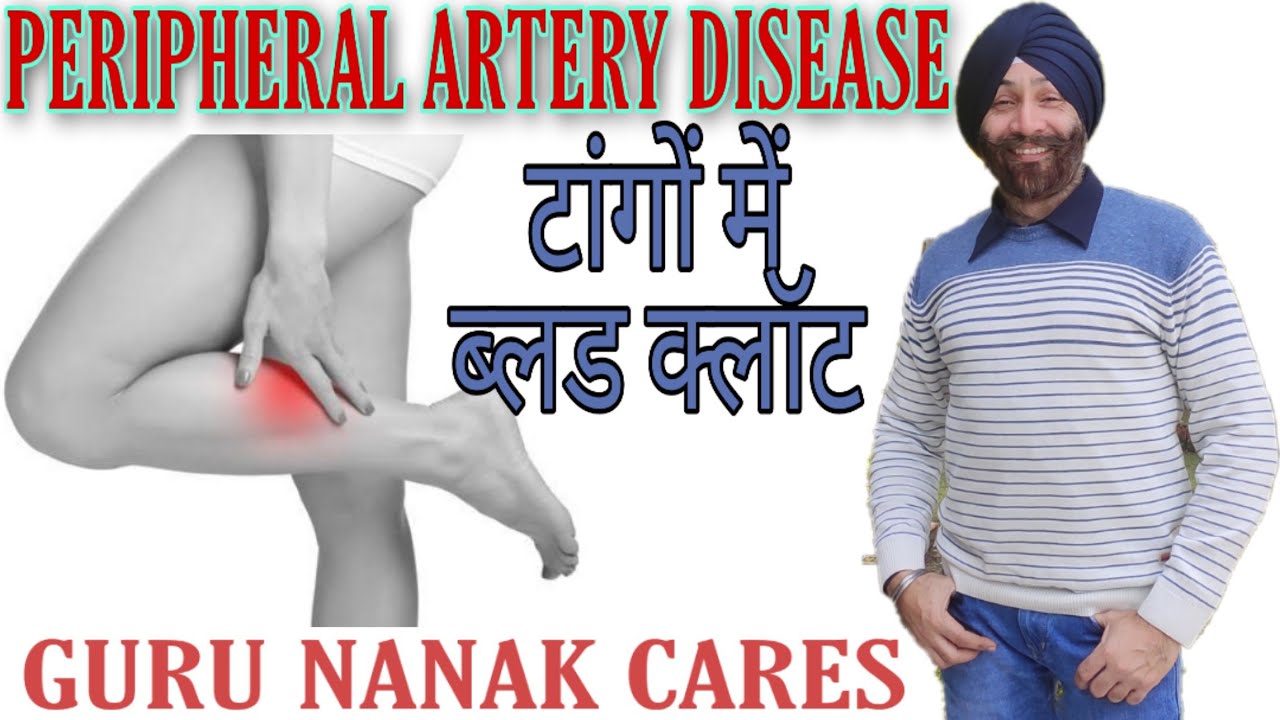 PERIPHERAL ARTERY DISEASE | टांगों में ब्लड क्लॉट | दर्द, सुन्नपन और जकड़न | Top Homeopathic Remedies