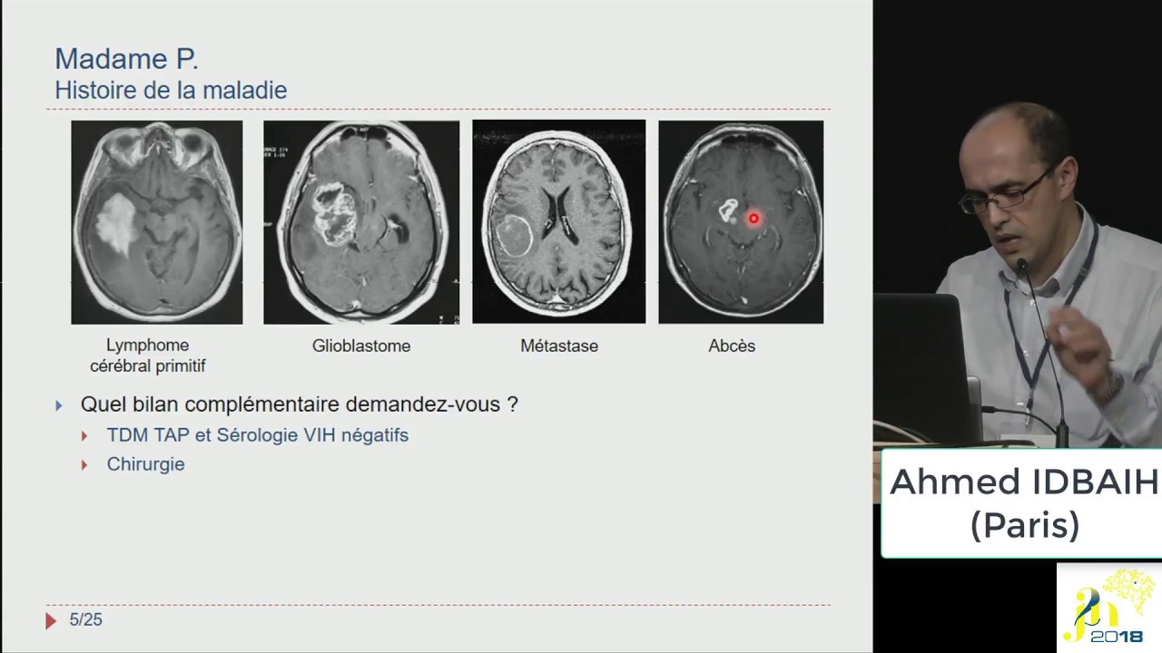 J2N 2018 - Session - Neuro-oncologie