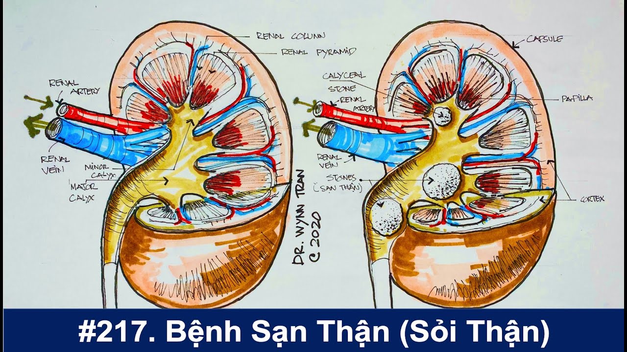 #217. Bệnh sạn thận (sỏi thận)