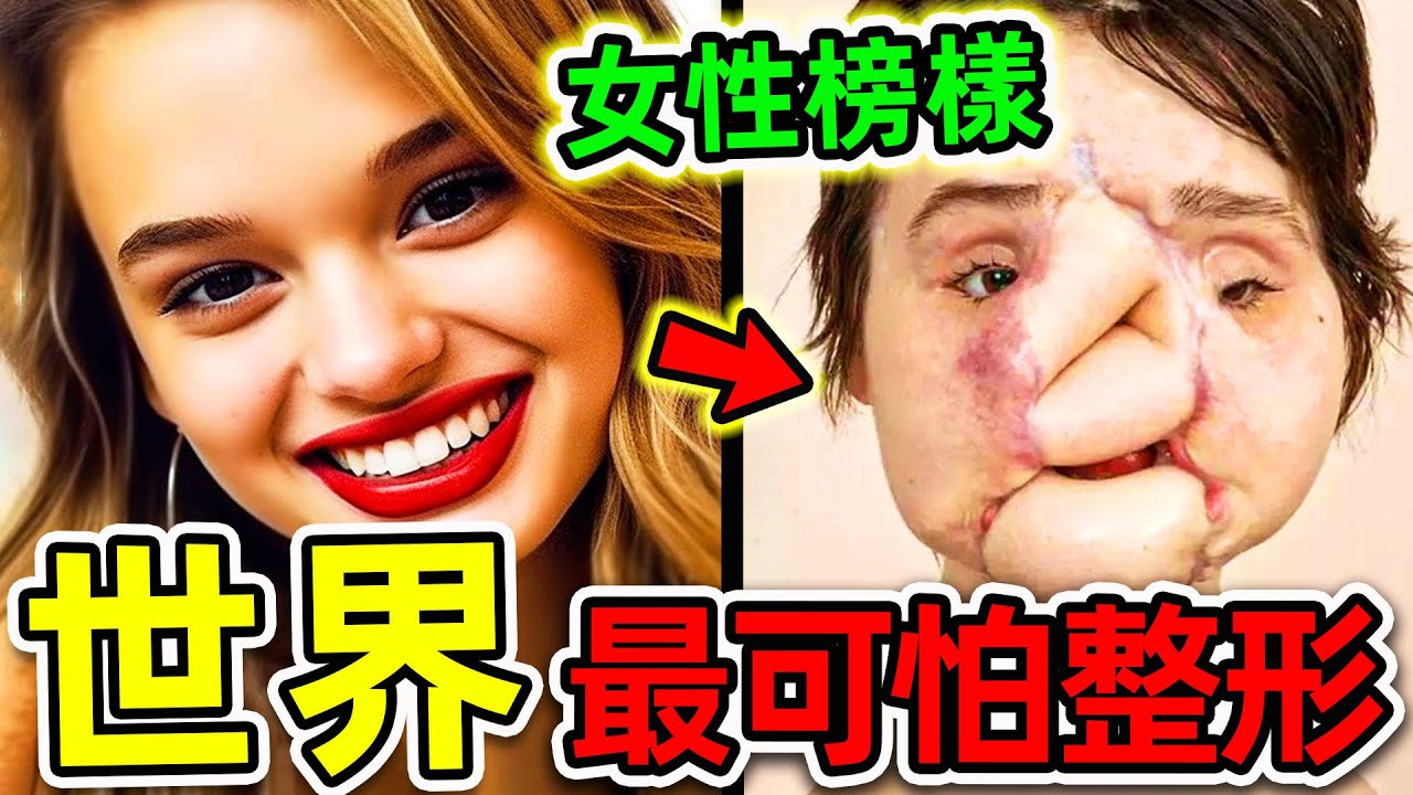 全世界最可怕的10個整形失誤！醫生錯誤造成&ldquo;扭曲五官&rdquo;，第一名堪稱人形怪物，男友當場被嚇尿。|#世界之最top #世界之最 #出類拔萃 #腦洞大開 #top10 #整形失誤 #最可怕整形