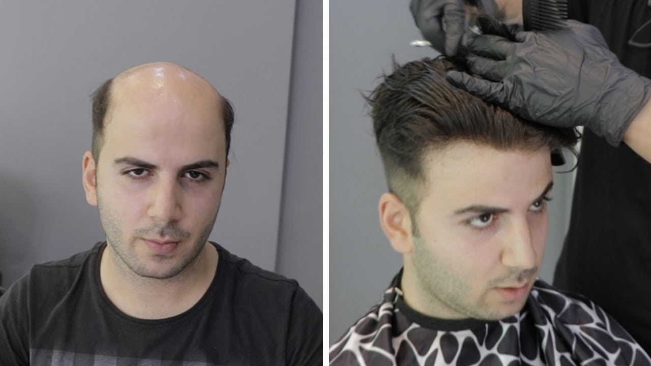Protez Saç Uygulaması - Hair Replacement