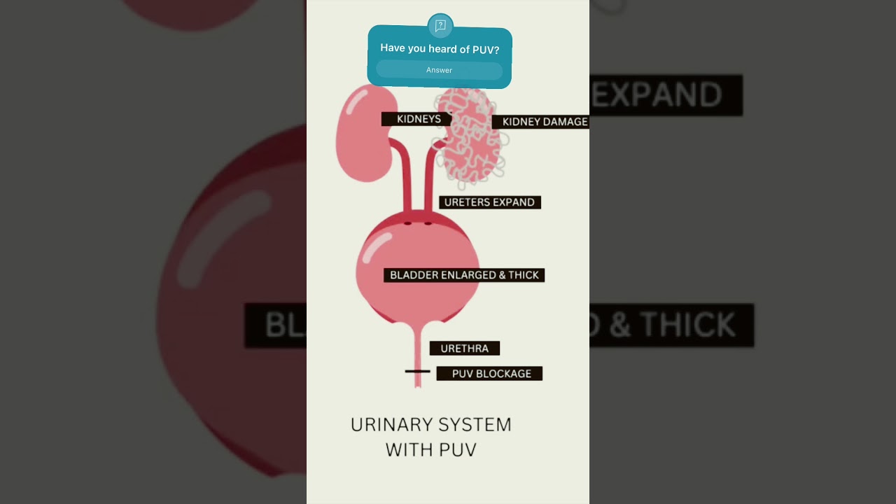 Sully&rsquo;s Disease: Posterior Urethral Valves #dialysis #baby #shorts #kidneyfailure y