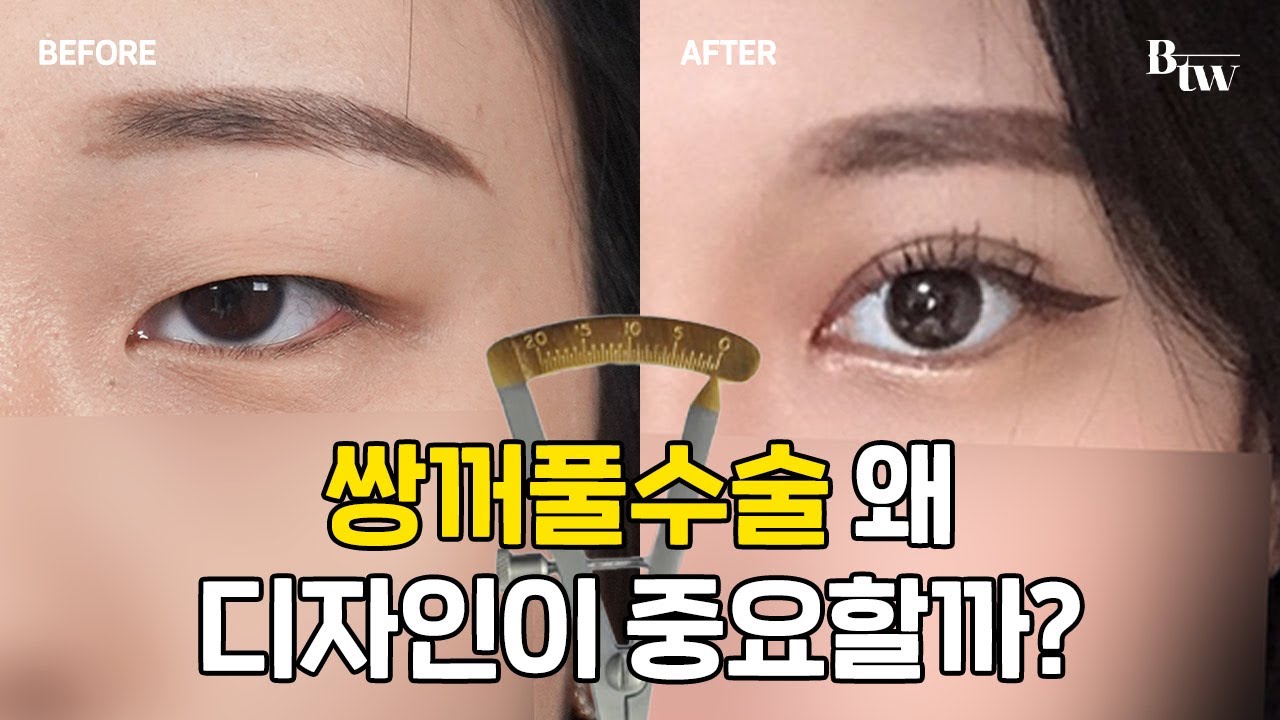 쌍꺼풀 수술 왜 디자인이 중요할까? | BTW성형외과