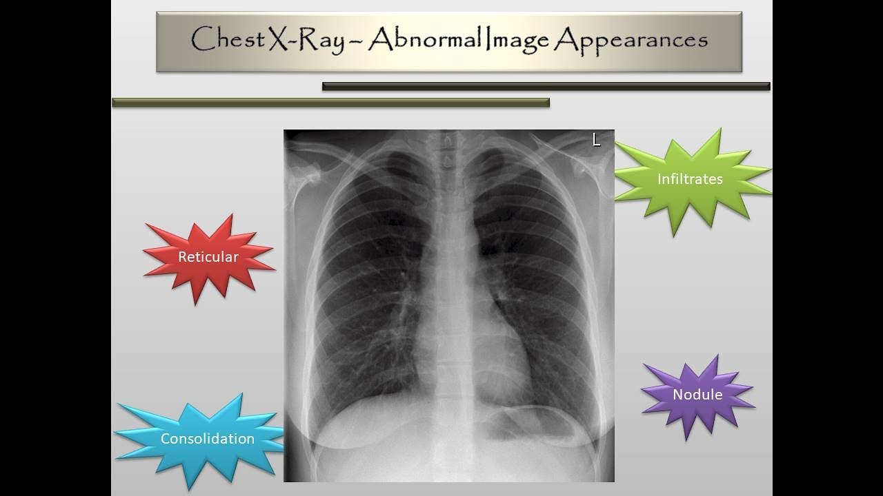 Chest X-Ray Abnormal Image Appearances