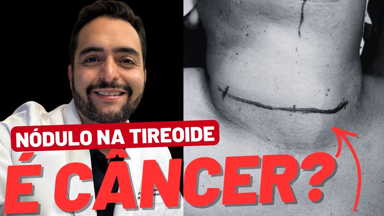 Todo nódulo na tireoide é câncer?