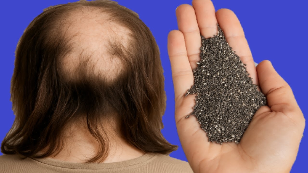 CABELO CRESCE IGUAL LOUCO E A CALVÍCIE VAI EMBORA e não cai mais! Esta é a receita mais poderosa!