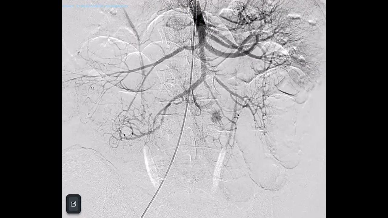 Embolizzazione arteria digiunale con microcatetere curvo