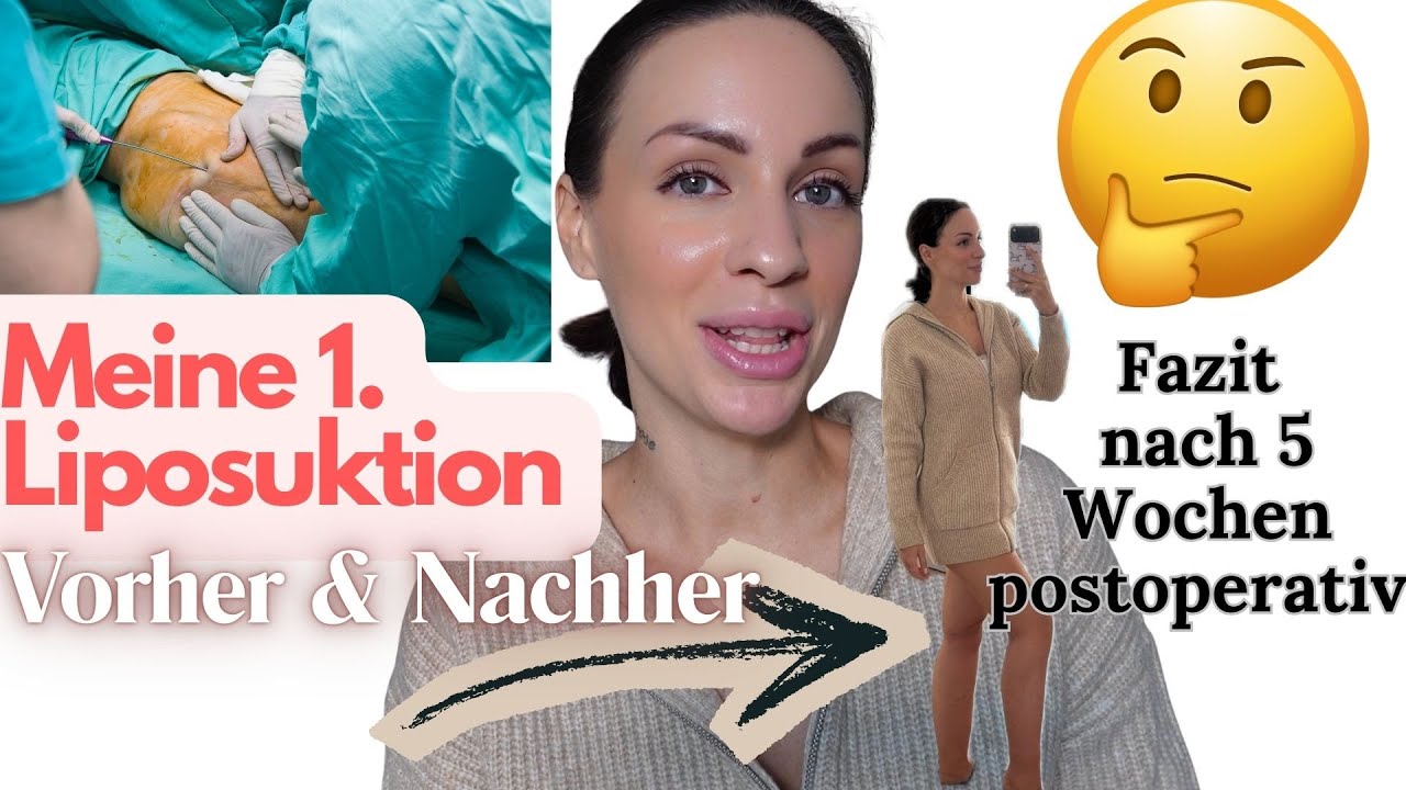Lymphgefäße bei Liposuktion beschädigt?!🦵🏼#lymphödem #liposuktion