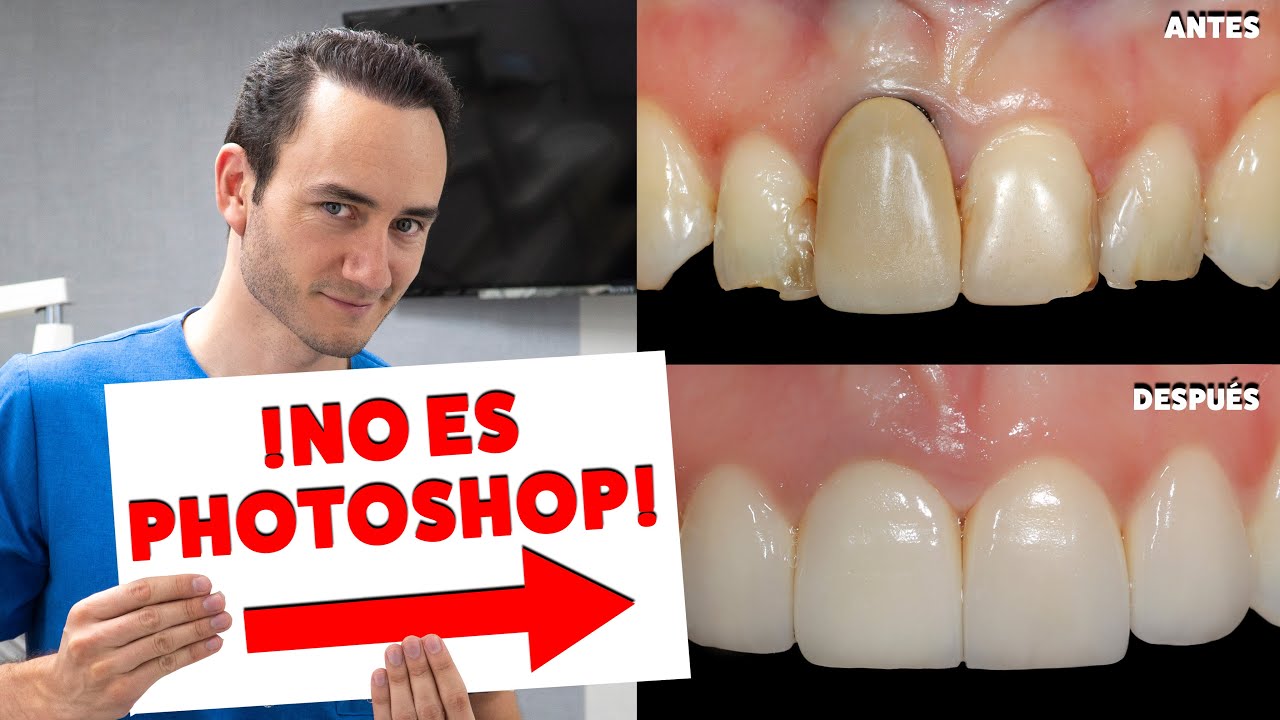 ¡CORREGIMOS UNA ENCÍA RETRAIDA SIN CIRUGIA! | Una Alternativa a los injertos | NO ES PHOTOSHOP
