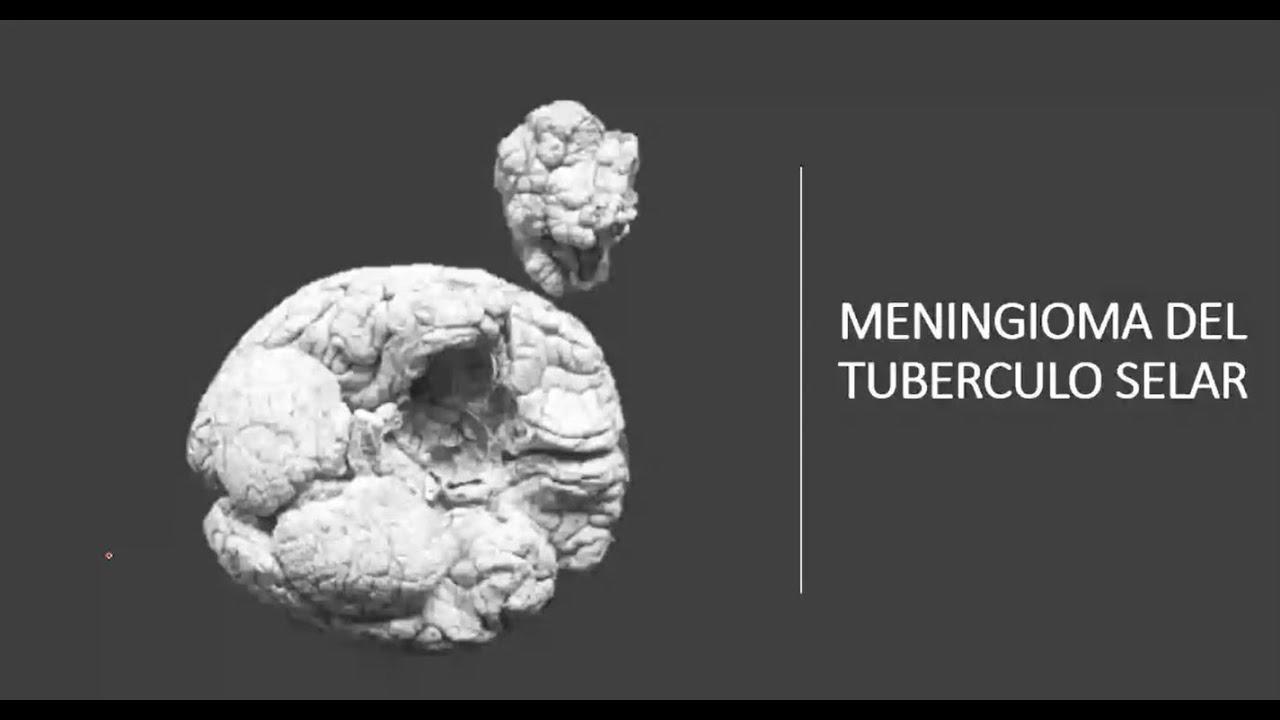 Meningiomas del tub&eacute;rculo selar
