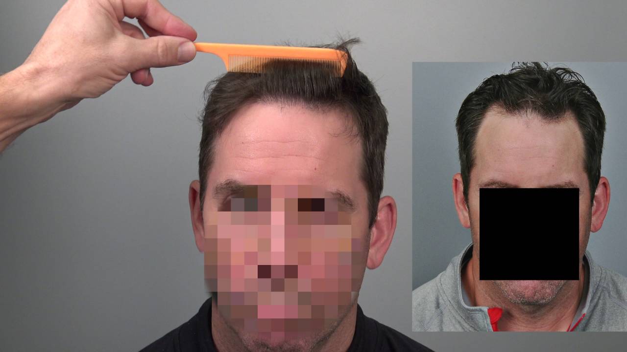 Excellent Hair Transplant Result with 3648 Grafts by Dr. Cooley