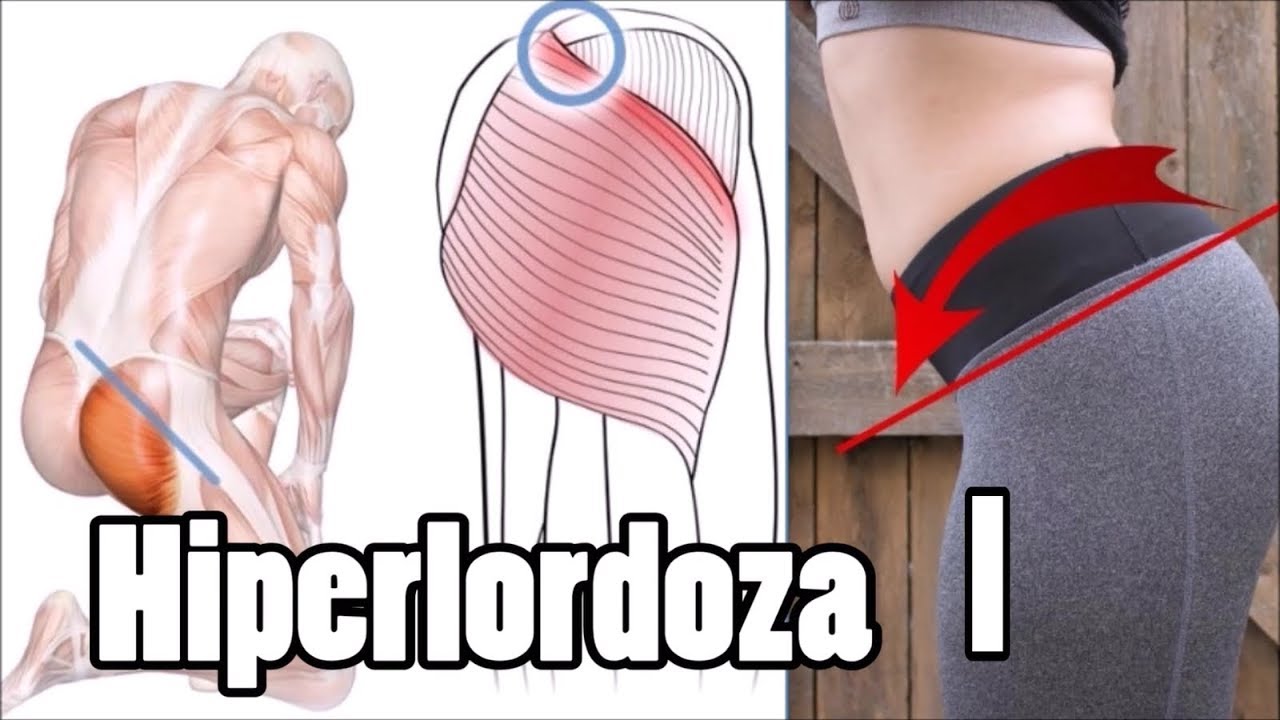 Pogłębiona lordoza lędźwiowa, ból pleców - JAK SKORYGOWAĆ cz.1 Anatomia