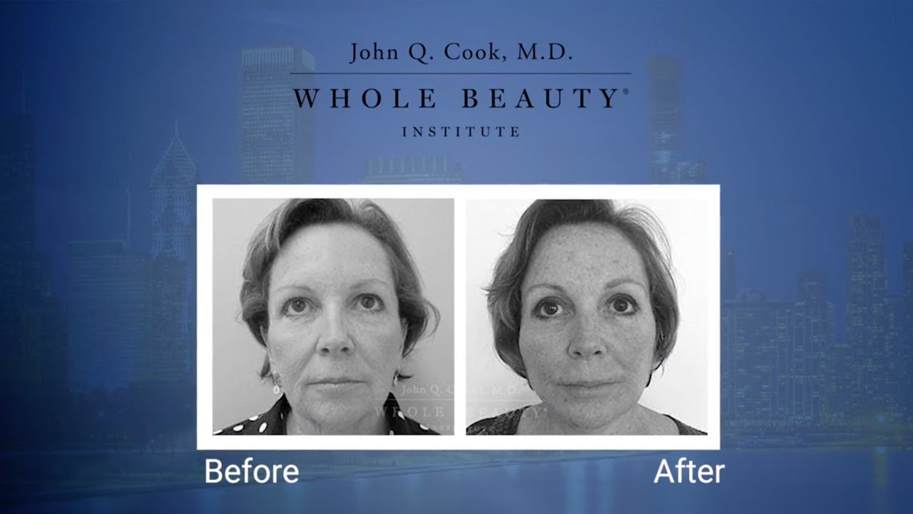 Preparing for a Face Lift