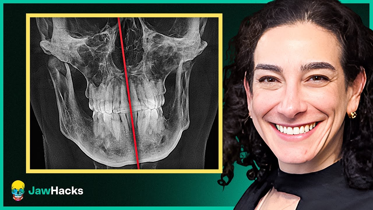 Why You Should Fix Asymmetries Before Maxillary Expansion
