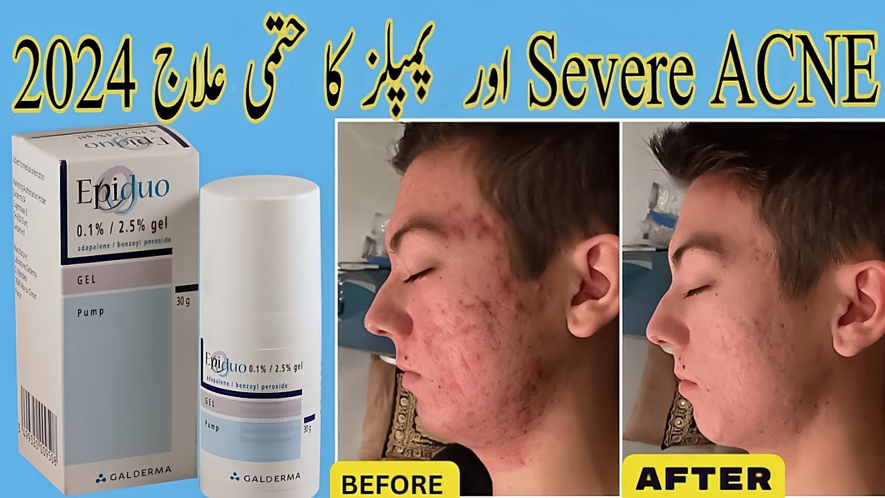 EPIDUO - How to Use EPIDUO Properly for Best Results 2024