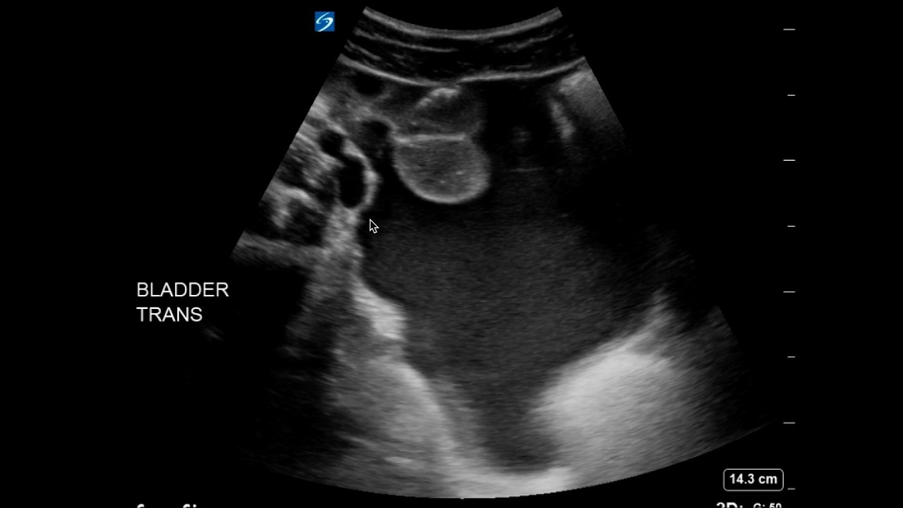 Positive FAST = Call Surgery: A Real ED Trauma Case Walkthrough