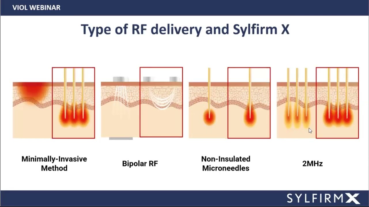[WEBINAR] Dual Wave Technology in SYLFIRM X by Dr. Jinah Yoo