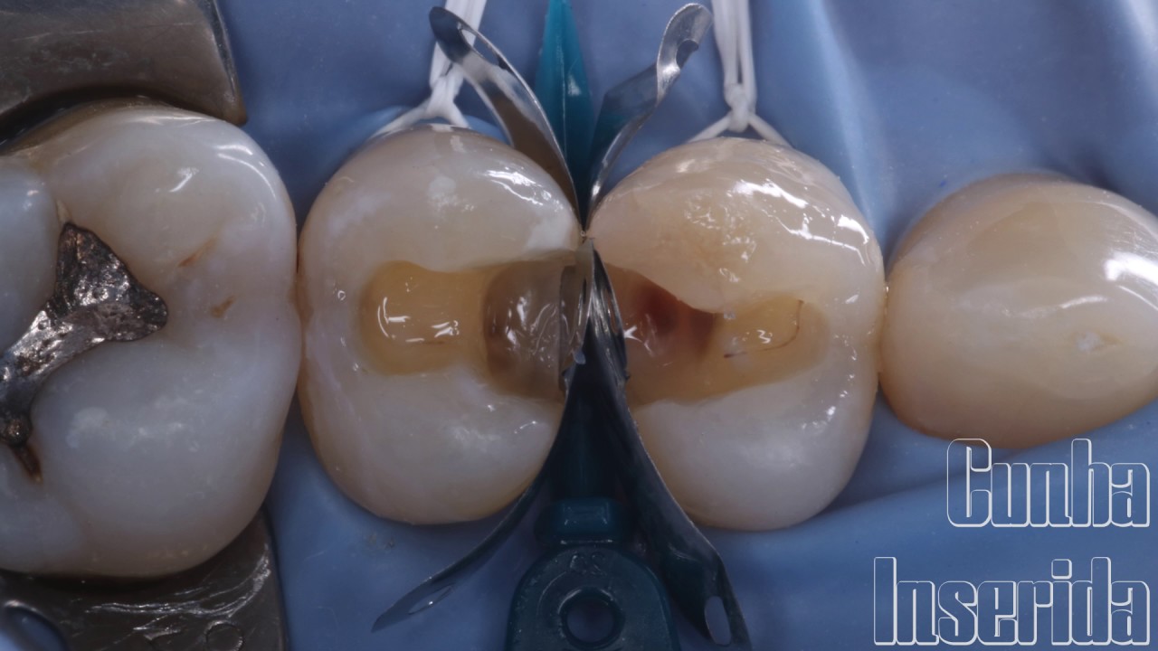 Matriz Palodent V3 para reconstrução de cavidades classe II